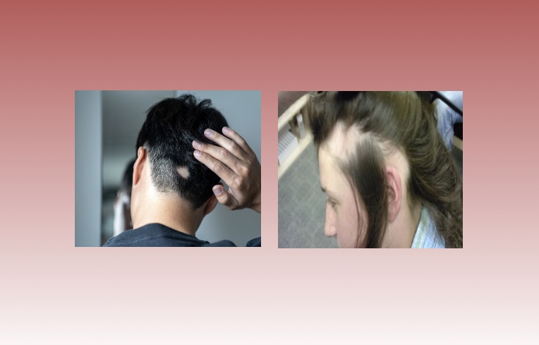 أسباب الإصابة بمرض الثعلبة.. وطرق الوقاية منه