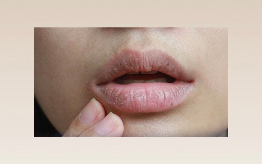 5 طرق طبيعية تساعد في العلاج من تقشر وجفاف الجلد حول الفم
