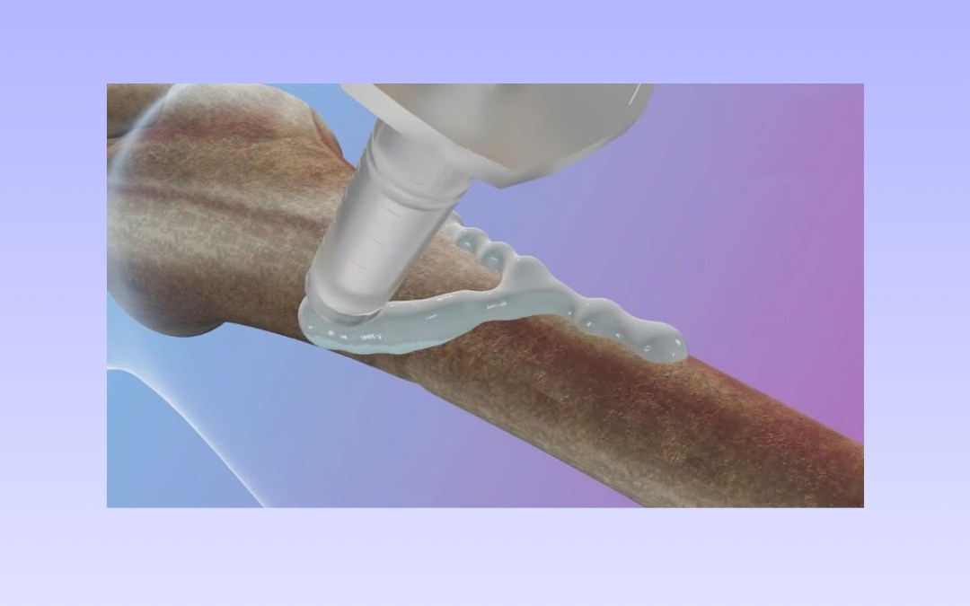 علماء صينيون يطورون “غراء عظمي” يصلح الكسور خلال 3 دقائق فقط